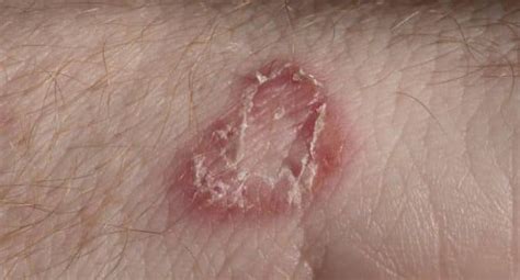 fungal infections   skin pictures images  meta pictures