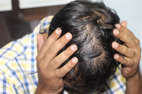 top  image seborrheic dermatitis hair loss thptnganamsteduvn