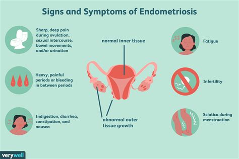 11 Natural Treatments For Endometriosis