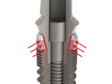 conical connection teeth  titanium