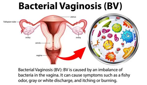 bacterial vaginosis bv  symptoms  treatment