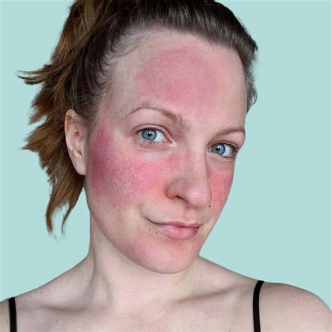 how to treat perimenopause rosacea perry