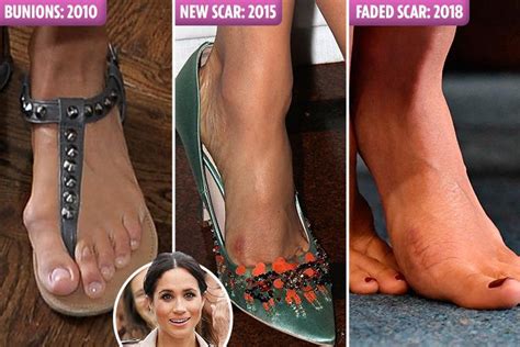 Meghan Markle ‘had Toe Breaking Surgery To Perfect Her