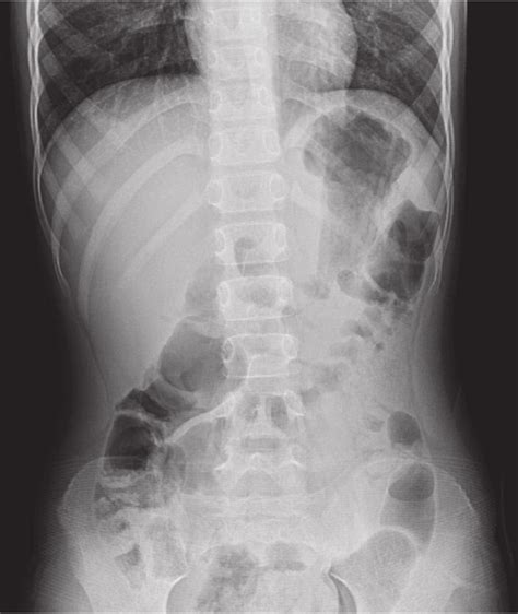 unremarkable plain abdominal radiograph  scientific diagram