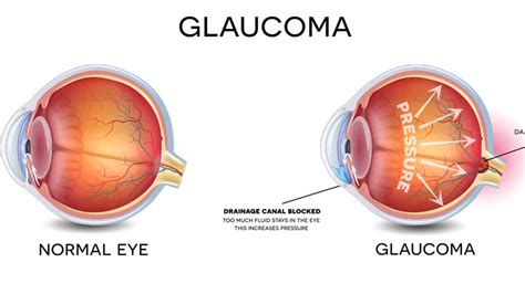 glaucoma stop silent thief  vision  guardian nigeria news