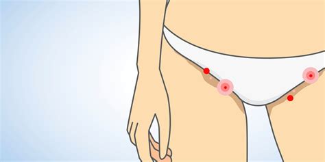 8 Common Causes Of Itchy Bumps And Lumps Around Your Vagina