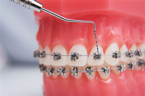 Orthodontics Treatment Everything To Know About Braces Dental Dost