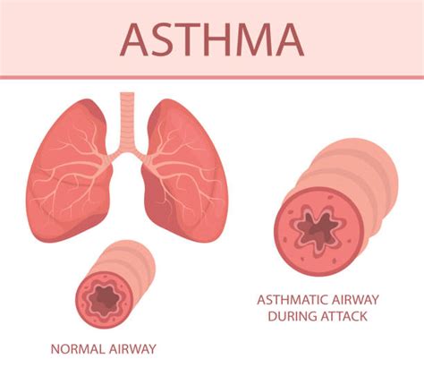 Asthmatic Illustrations Royalty Free Vector Graphics And Clip Art Istock