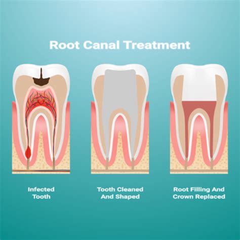 root canal knoxville therapy   visit dr jack haney