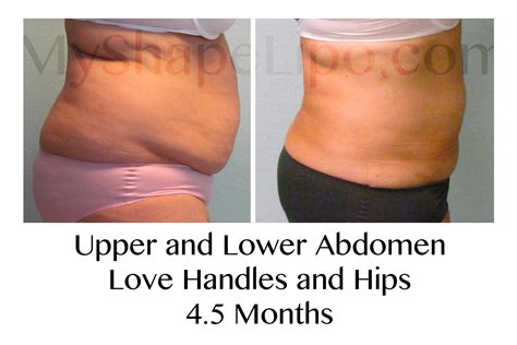 myshape lipo saves  womans life  large volume liposuction