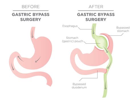Gastric Bypass Surgery Promises Remission Of Type 2 Diabetes