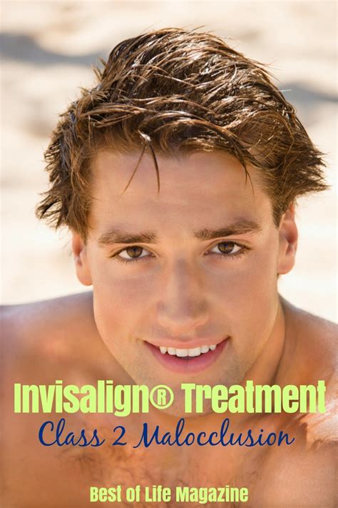 Class 2 Malocclusion With Invisalign® Treatment Best Of Life Magazine