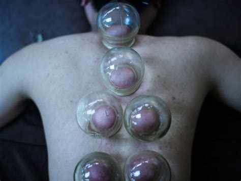 there s no evidence cupping works why is it so popular