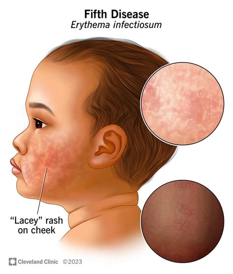disease erythema infectiosum symptoms  treatment