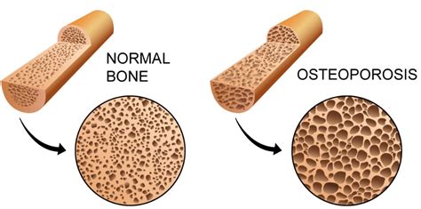 all about osteoporosis definition risk factors and treatment