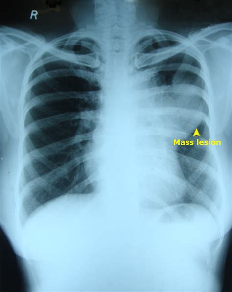 Mass Lesion Chest X Ray « Pg Blazer