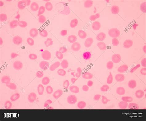thalassemia blood image photo  trial bigstock