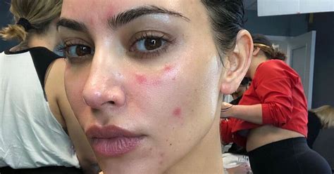 kim kardashian s tears over psoriasis flare ups at most important