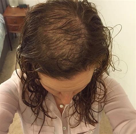 hair loss  trichotillomania   cover  bald patches pretty