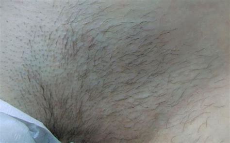 Before And After Hair Removal Results Clhr