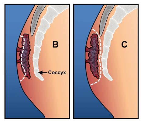 pilonidal disease ascrs