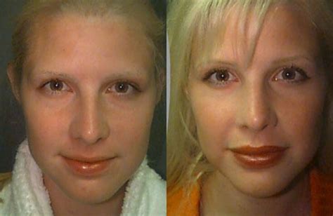 Facial Implants Before And After Nude Moives