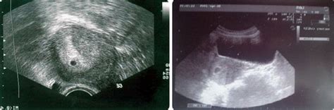 four weeks pregnant ultrasound kamasutra porn videos