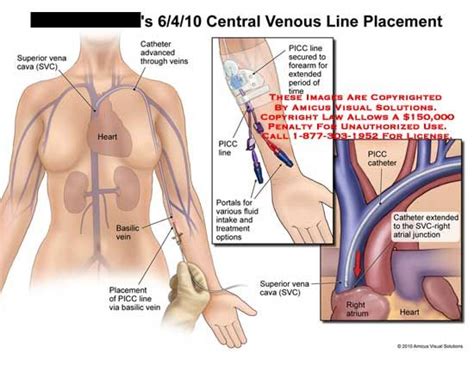 central venous  placement nursing study emergency medicine medical