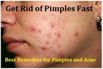 rid  pimples fast   remedies  acne   works