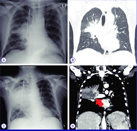 Chest X Ray A And Ct Scan Of The Chest B Showed Lobar Pneumonia In
