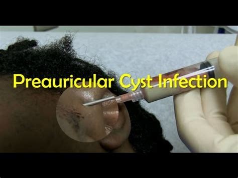 preauricular sinus  cyst