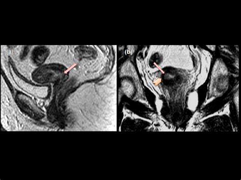 cervical cancer staging through magnetic resonance imaging mri — what