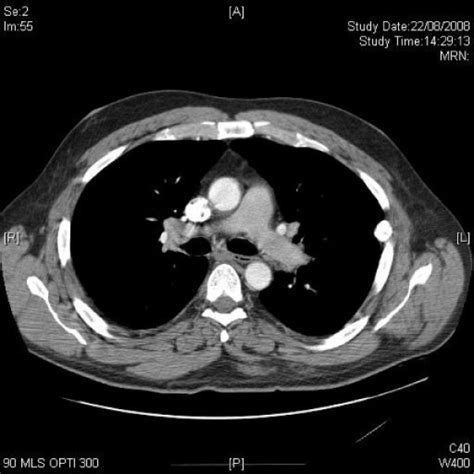 Axial Ct Of Lung Hila Shows Hilar Lymphadenopathy Open I