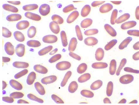 hemolytic anemias hematology hematology oncology with