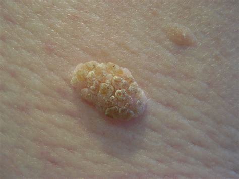 seborrheic keratosis treatment glasgow  clinic