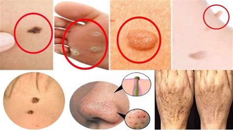 moles warts and skin tags removal review should you use it