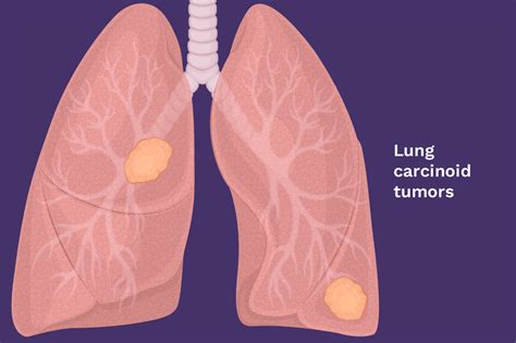 Understanding The Different Types Of Lung Cancer Meefro