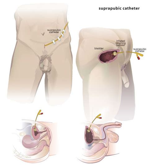 Sexy nurse foley catheter insertion