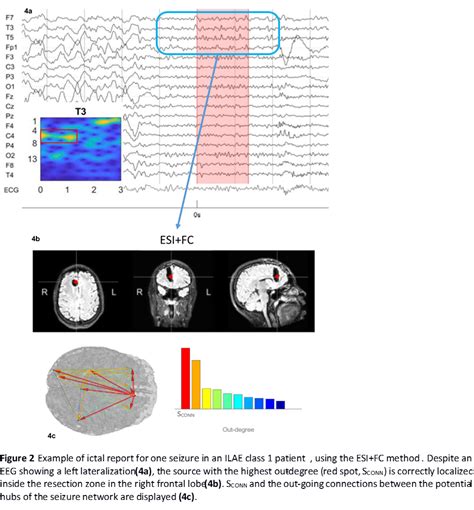 ictal eeg source imaging  connectivity  localize  seizure onset