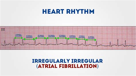 Ekg Rhythm Strip Sample Reports How To Read An Ecg Ecg