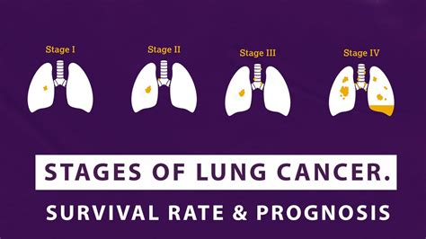 Stages Of Lung Cancer – Survival Rate And Prognosis Macs Clinic