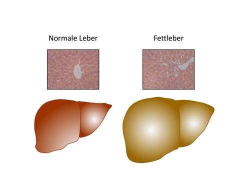 Trigger For Fatty Liver In Obesity Found