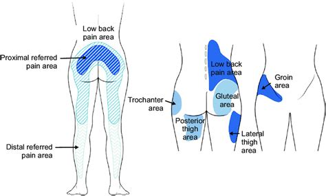 illustration  distribution pattern related  facet joint pain