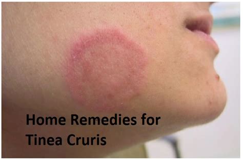 12 Best And Effective Home Remedies For Tinea Cruris Home Remedies 2 U