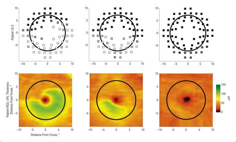 retinal ganglion cell layer thickness  local visual field