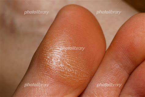 足の親指の角質 写真素材 [ 6820746 ] フォトライブラリー Photolibrary