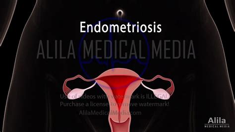 Alila Medical Media Gynecology And Obstetrics Images And Videos