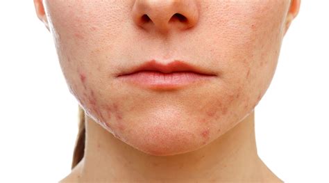 acne marks  acne scars differences treatments sozo clinic