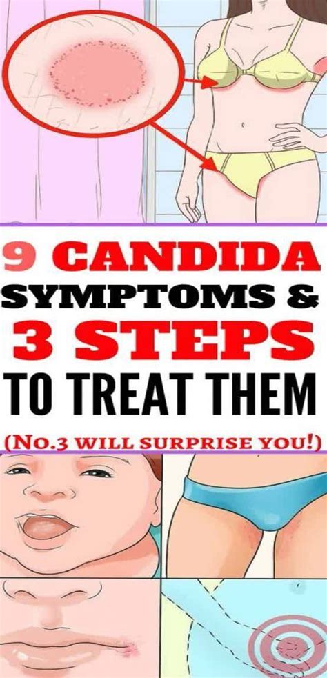 9 Candida Symptoms And 3 Steps To Treat Them Wellness Days