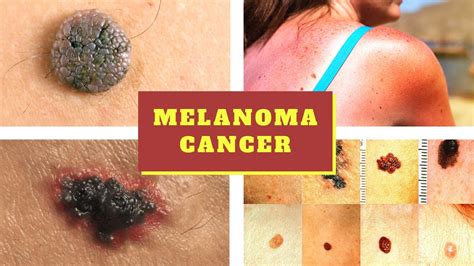 melanoma symptoms causes pictures stages signs and